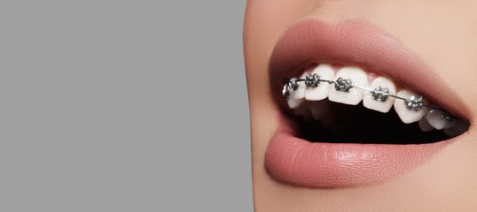 Saint genis pouilly-orthodontiste-Dr Quinty-enfants- adolescents-Invisalign-Aligneurs-aligners