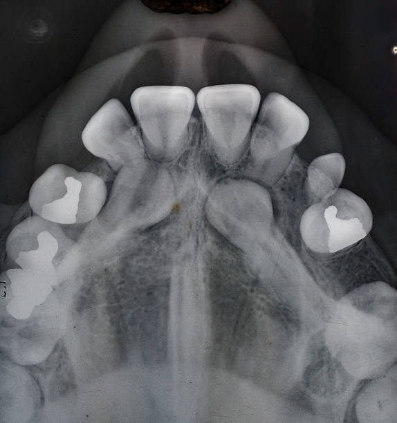 Les canines incluses | Dr Olivier Quinty | Cabinet d’orthodontie à ...