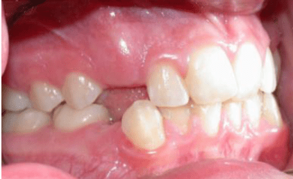 Les canines incluses | Dr Olivier Quinty | Cabinet d’orthodontie à ...