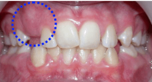 Pays de gex-orthodontie-Dr Quinty-enfants-adolescents-Invisalign-aligners, aligneurs 
