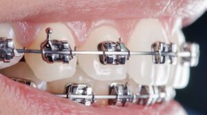 Quinty importance de l'orthodontie